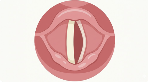 Diagram showing unilateral vocal cord atrophy.