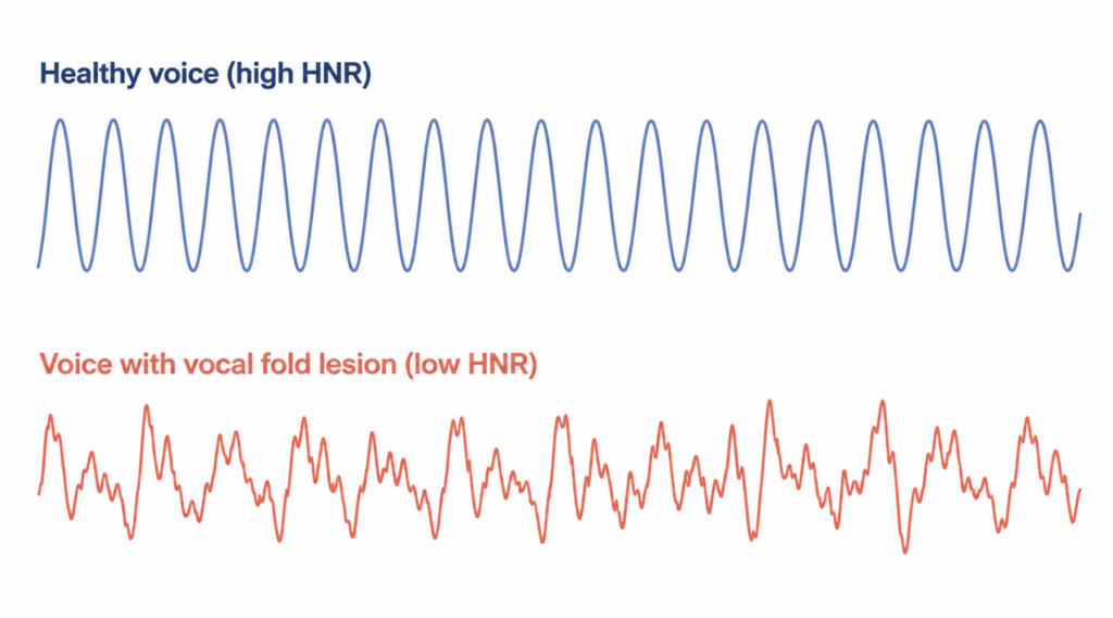 Waveform comparison: healthy voice with high harmonic-to-noise ratio versus voice with vocal fold lesion showing low HNR