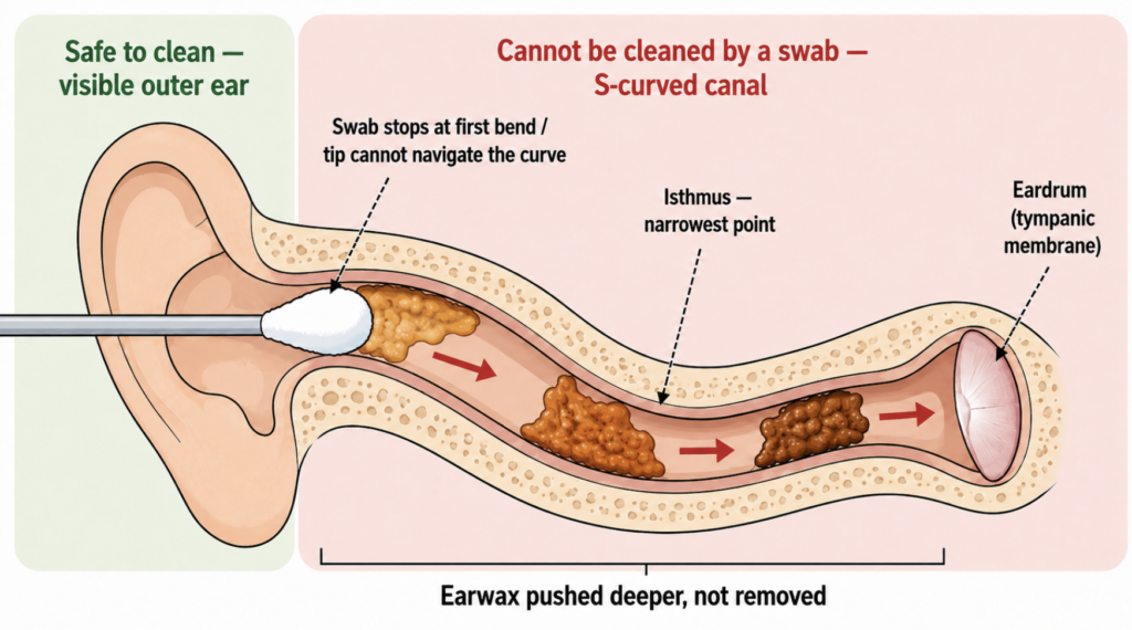 Cross-section diagram showing the S-shaped external auditory canal with a cotton swab unable to follow the curve, pushing earwax deeper toward the isthmus and eardrum