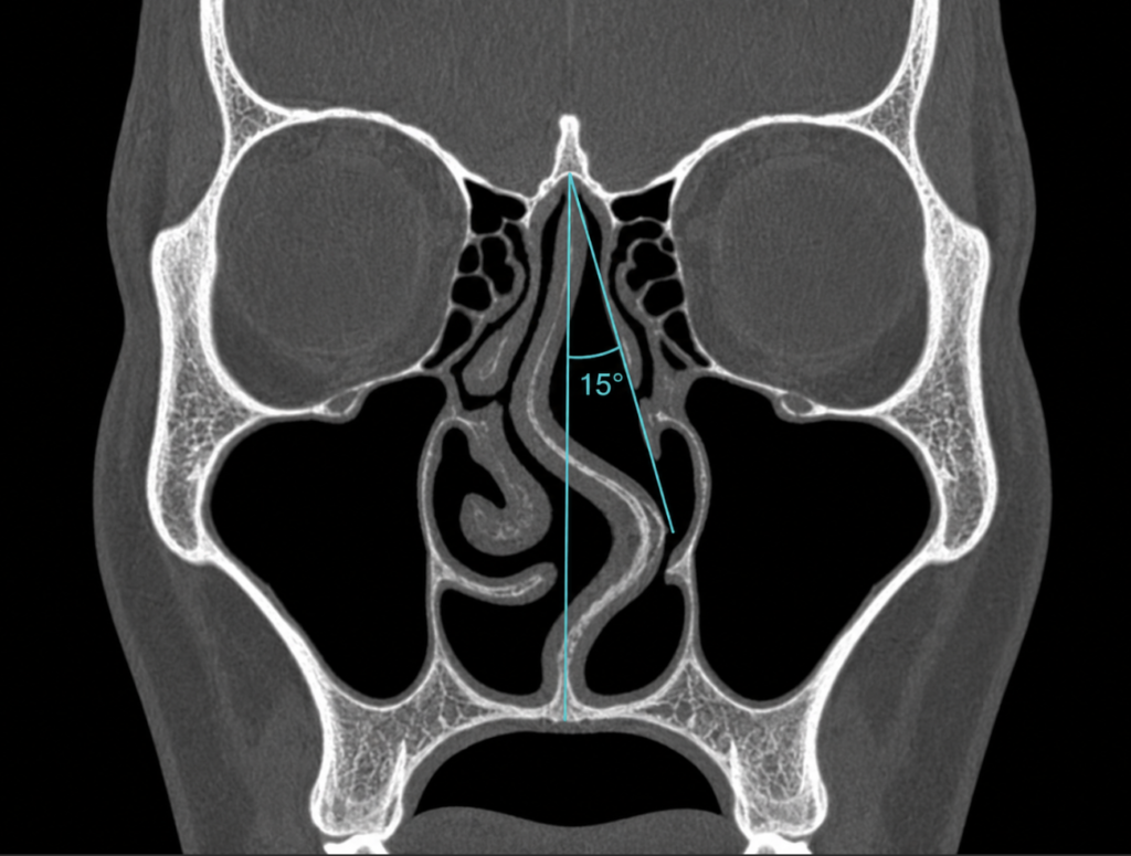 Coronal CT scan showing septal deviation angle measurement from crista galli
