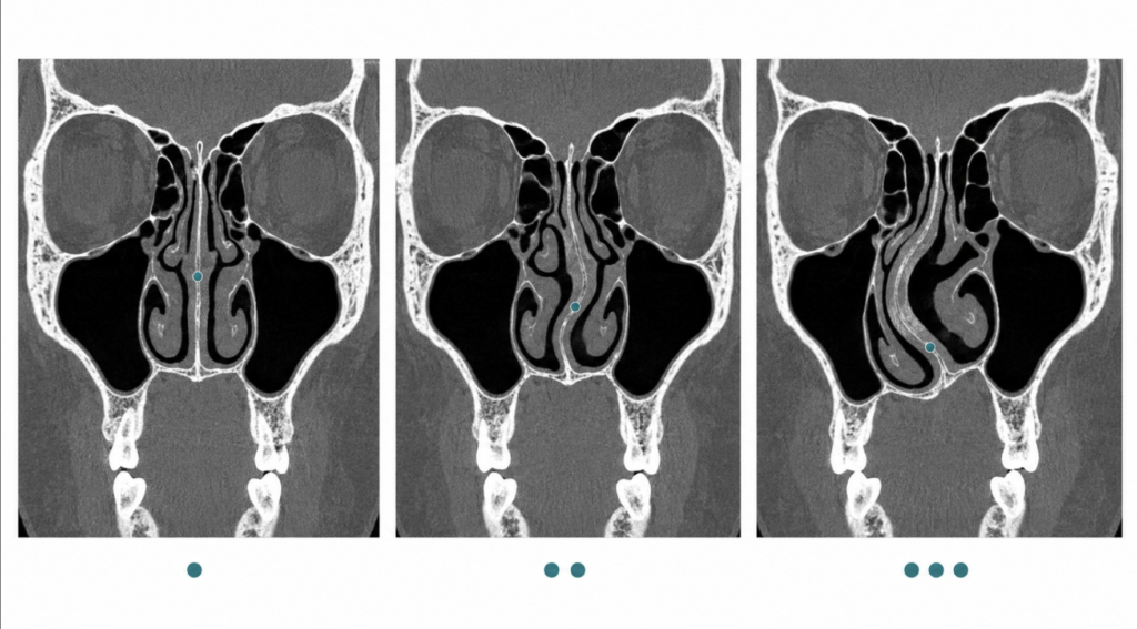 Side-by-side comparison of mild, moderate, and severe nasal septum deviation on CT