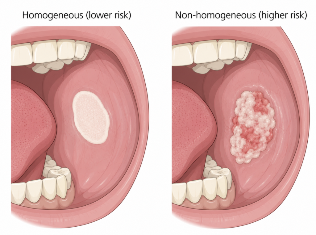 Comparison of homogeneous and non-homogeneous leukoplakia clinical appearance illustration