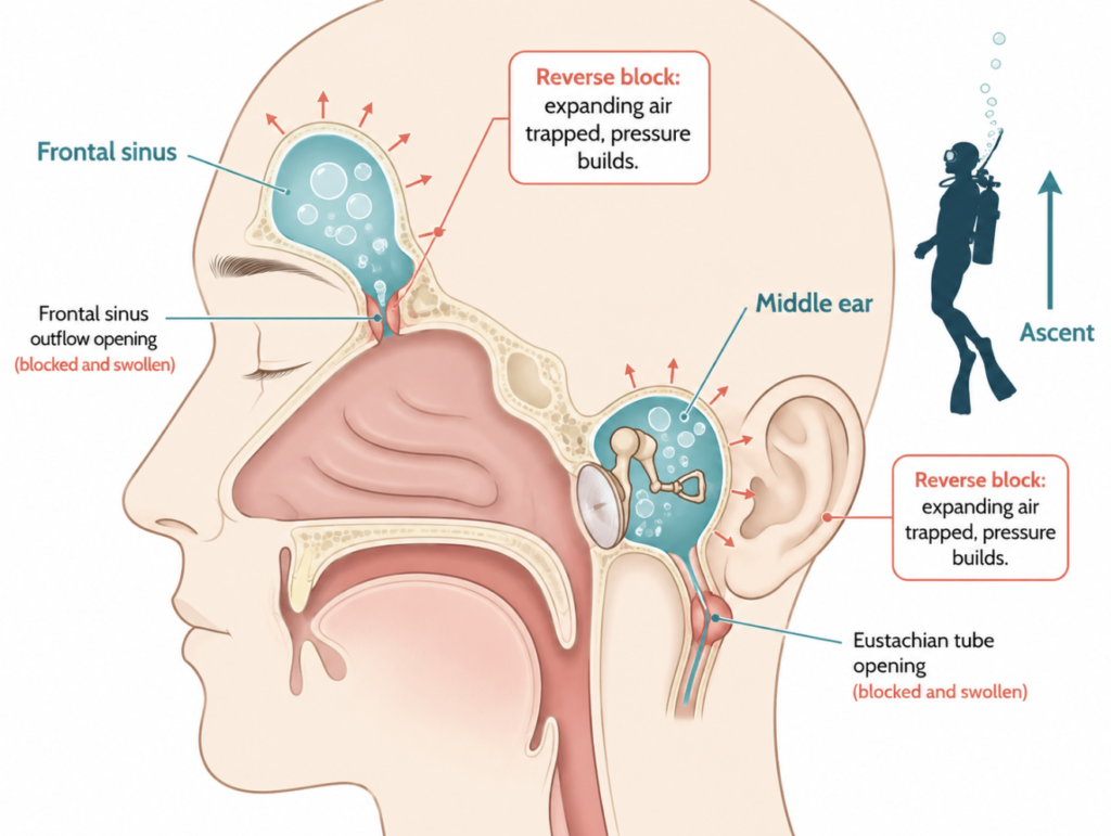 Reverse block: trapped expanding air in the sinus and middle ear during diving ascent
