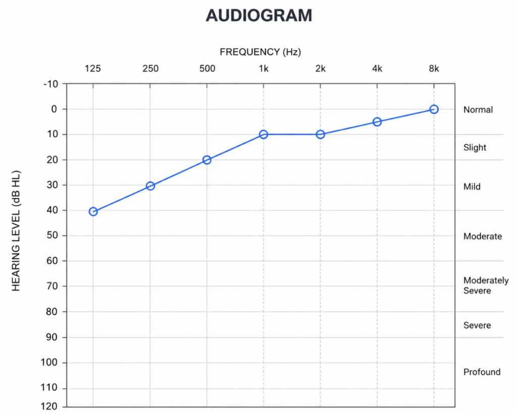 Audiogram showing an isolated low-frequency sensorineural hearing loss pattern