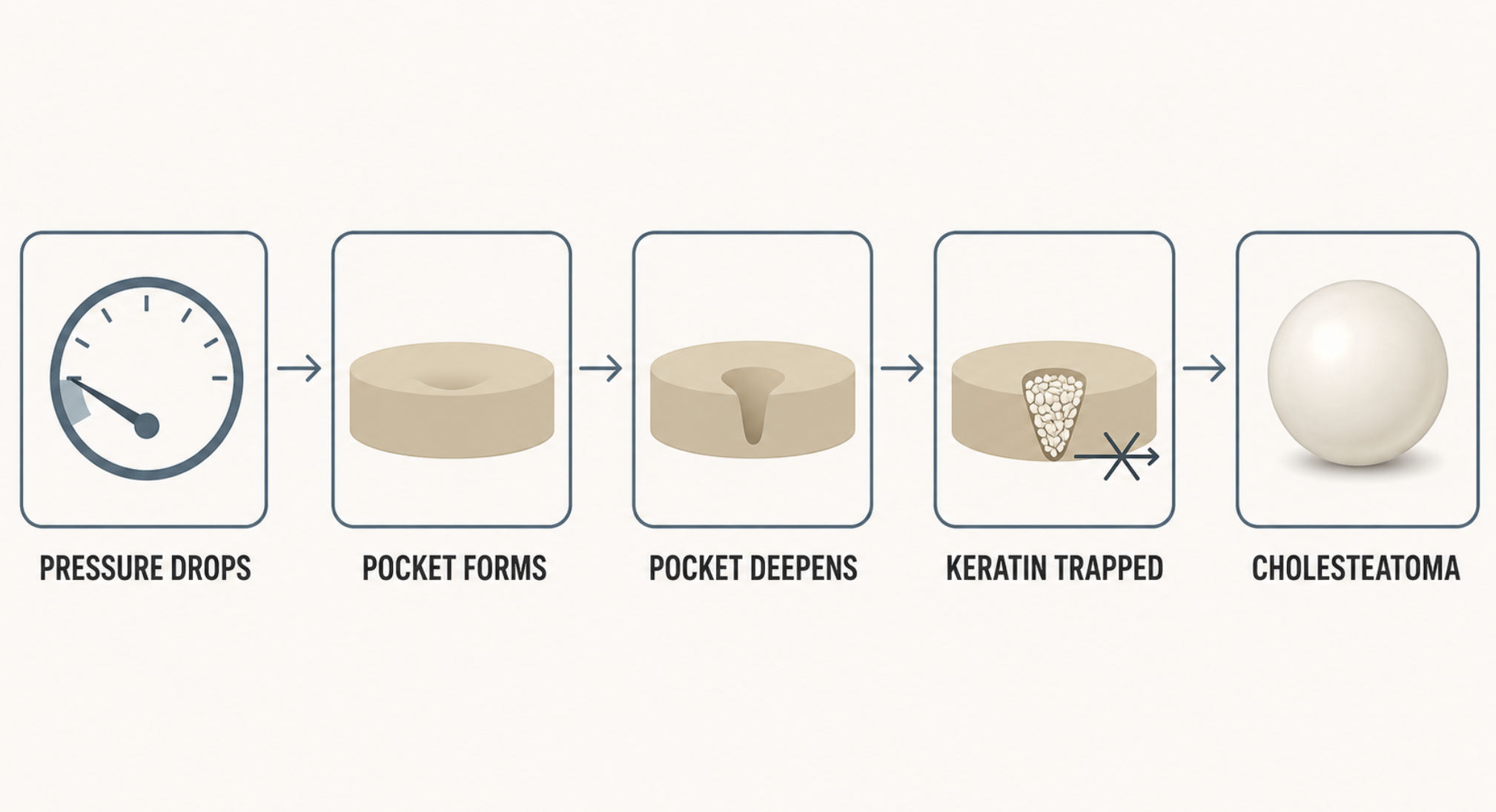 Five-step flow diagram of cholesteatoma formation from poor middle ear ventilation to trapped keratin