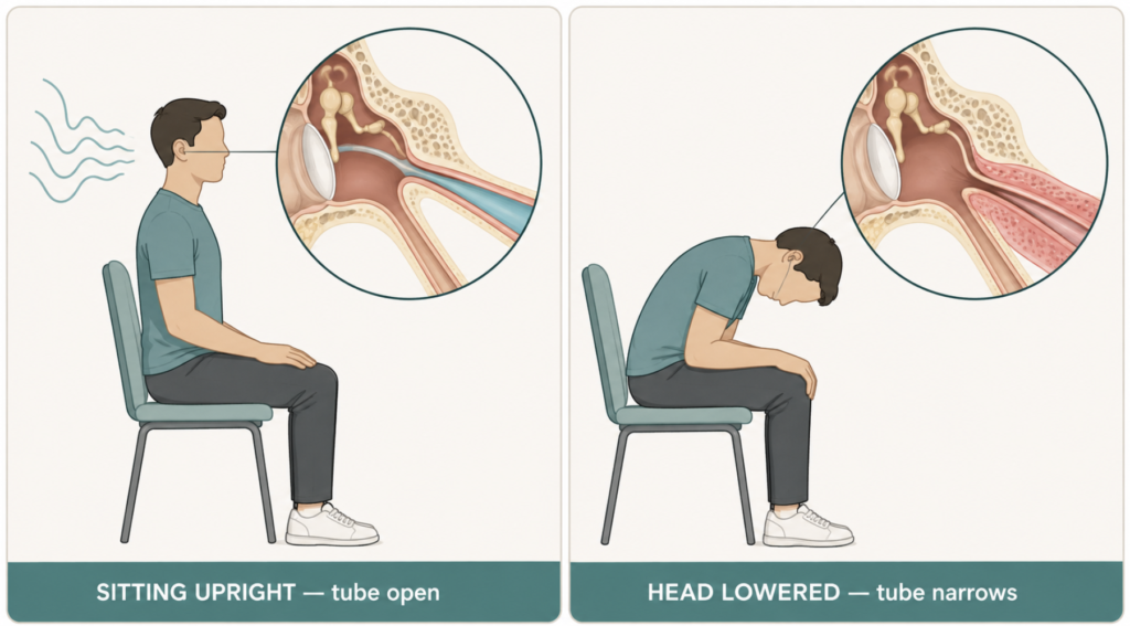 Illustration showing how lowering the head narrows a patulous eustachian tube and eases autophony