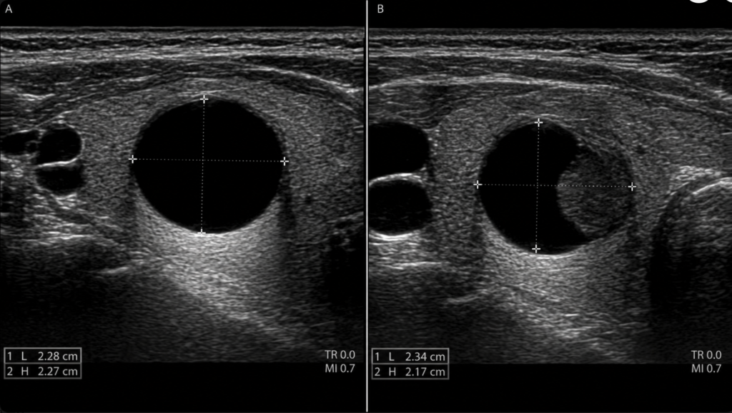 Ultrasound images comparing a simple thyroid cyst and a partially cystic thyroid nodule
