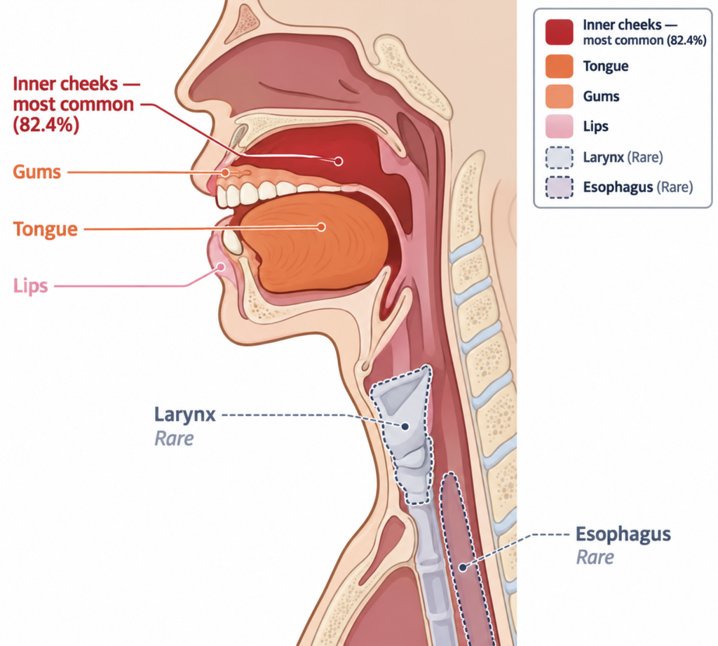 Side-view diagram of the mouth and throat showing the inner cheeks as the most common site of oral lichen planus, followed by the tongue, gums, and lips