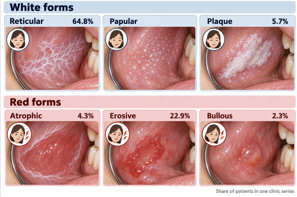 Grid of the six forms of oral lichen planus, with reticular, papular, and plaque as white forms and atrophic, erosive, and bullous as painful red forms